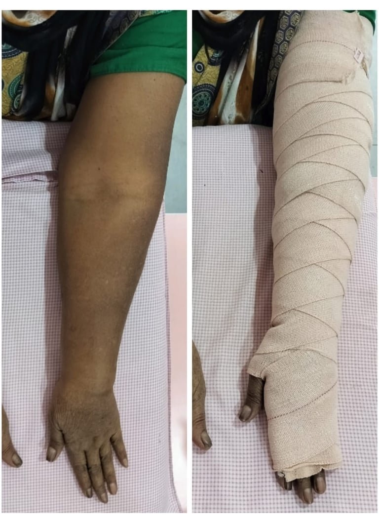 The affected arm, and the same arm with compression bandaging.