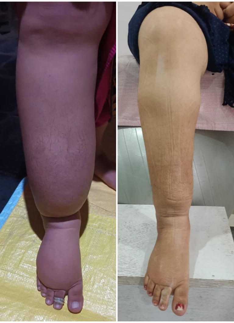 The leg before treatment (left) and after three months of sessions (right).